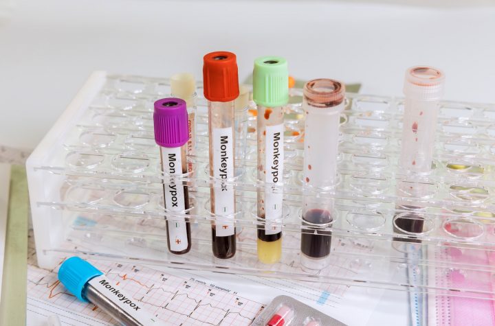Laboratory in check-up analysis blood test for smallpox Monkey infection blood test