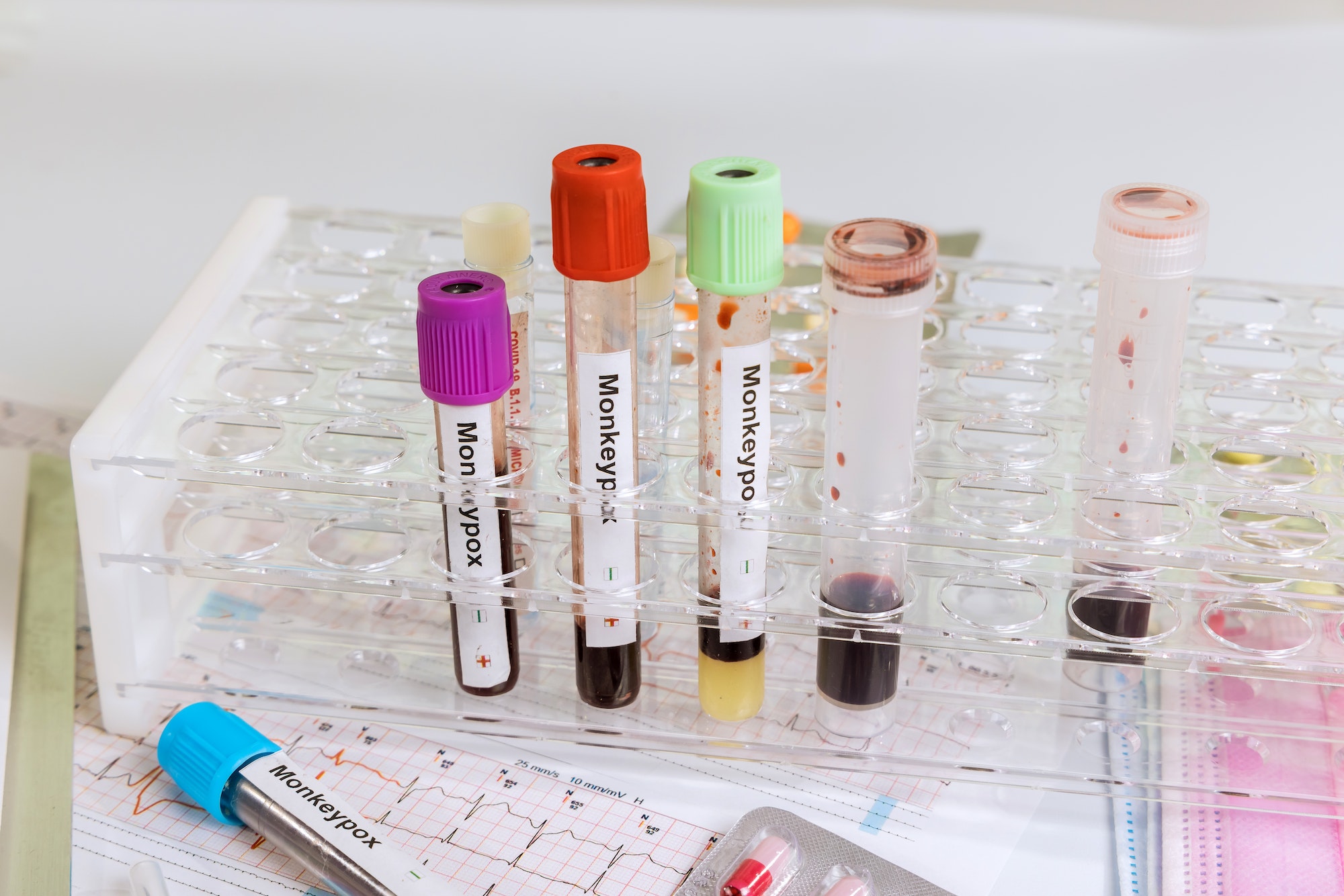 Laboratory in check-up analysis blood test for smallpox Monkey infection blood test